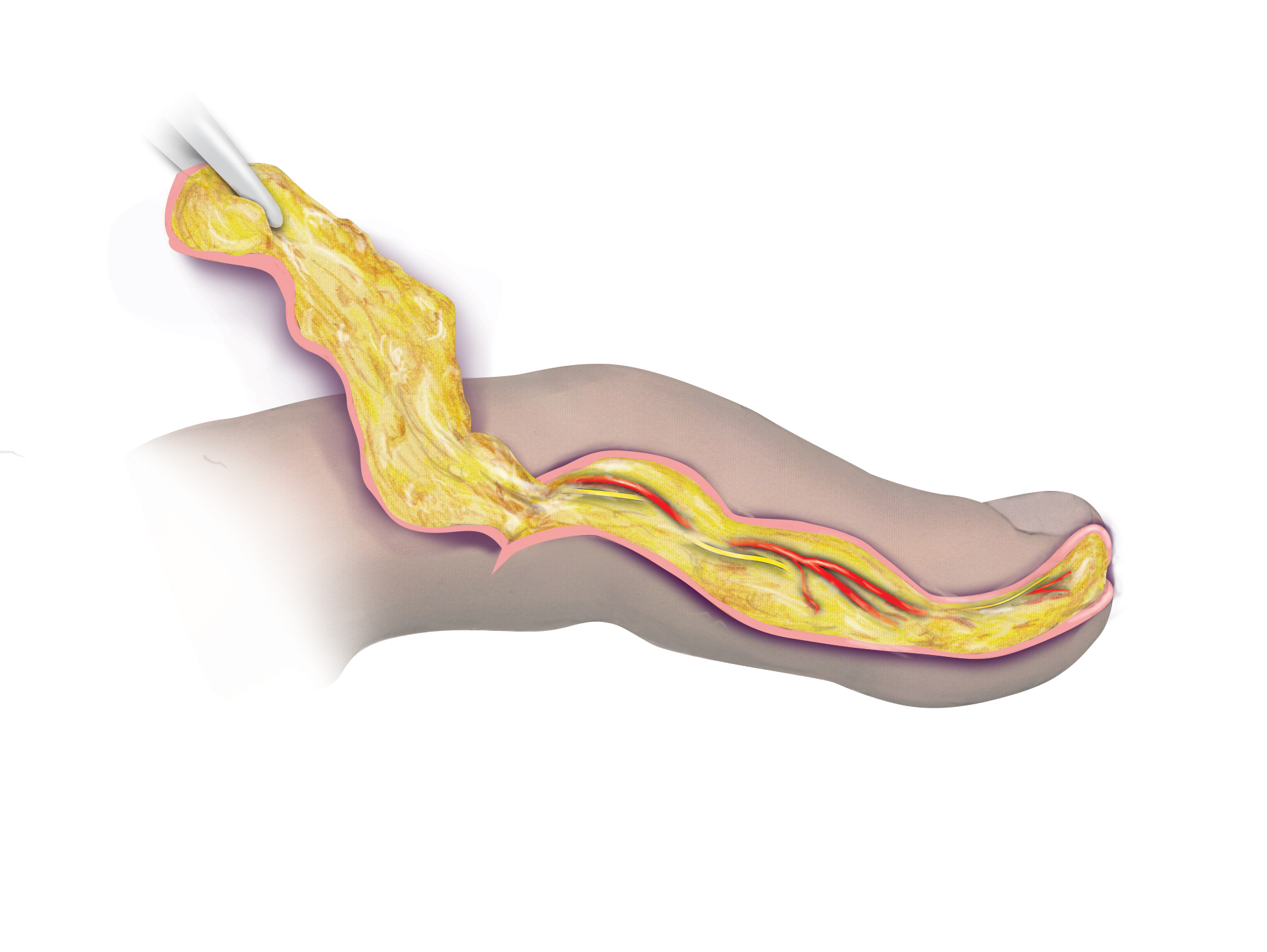 Debulking of the radial side of the long finger. Note uninvolved digital nerve and digital artery.