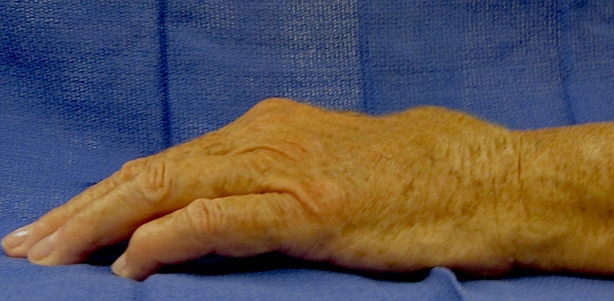 Extensor Tendon Ruptures (Vaughan-Jackson Syndrome)