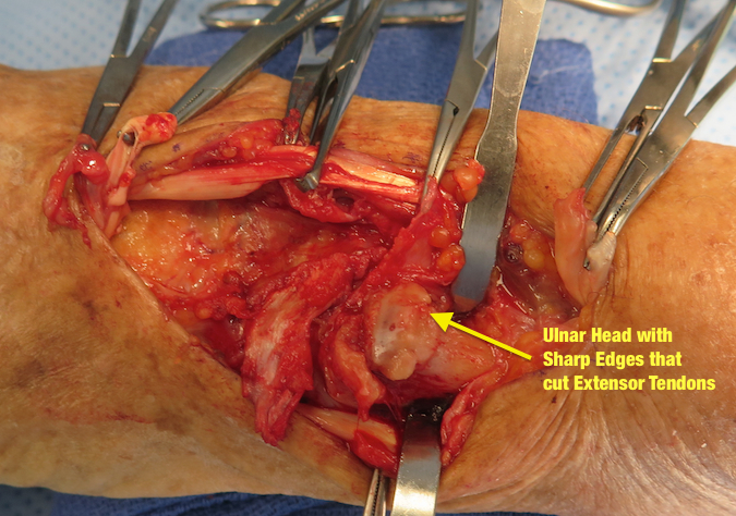 Arthritic Ulnar Head exposed with osteophytes that acted as sharp teeth which ruptured the extensor tendons