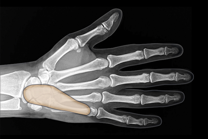 The ulnar bursa which can connect to the radial bursa and flexor sheaths of thumb and little finger to form "horseshoe" abscess.