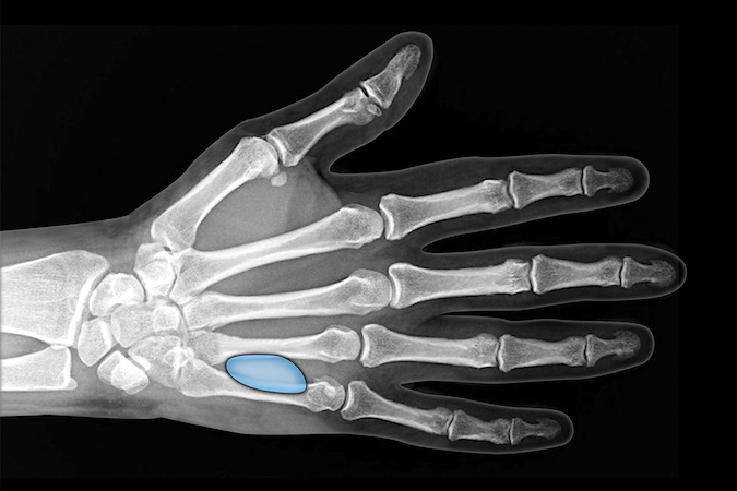 The hypothenar space is a potential space between the combined palmar and superficial hypothenar muscle fascia and the deep hypothenar muscle fascia. Infection is usually secondary to a puncture wound.