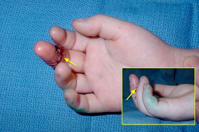 Right long finger FDP laceration at the DIP joint level (arrow) with lack of DIP flexion (insert)