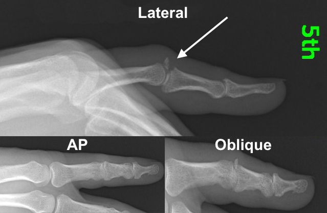 Central slip avulsion fracture (arrow) Lateral, AP and oblique views