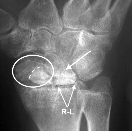 SNAC Wrist with scaphoid (oval) to be excised; dotted line nonunion; R-L intact cartilage and (arrow) destroyed Lunate-capitate joint.