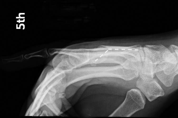 Boxer's fifth metacarpal neck fracture Lateral.  Note dorsal apex angulation (dotted line)