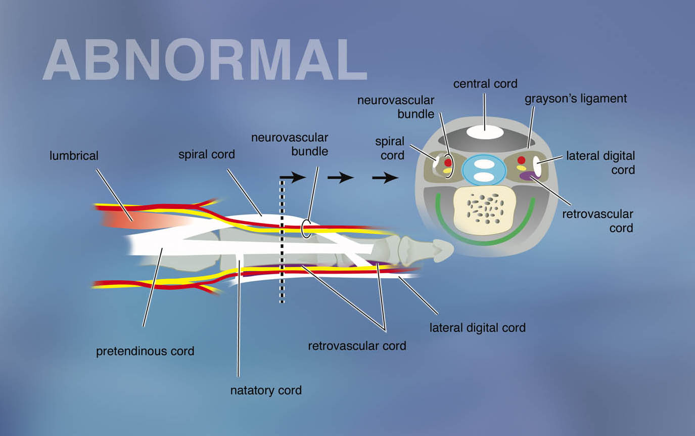 The pathologic cords of Dupuytren's disease that originate from the fascia bands. Note the cross sectional digital diagram with the pathologic cords.