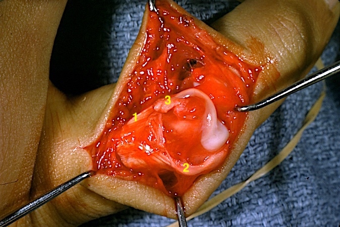 Complex PIP dislocation with 1 - lateral band displaced into the PIP joint;   2 -edge of the central slip  ; 3 - ruptured collateral ligament .