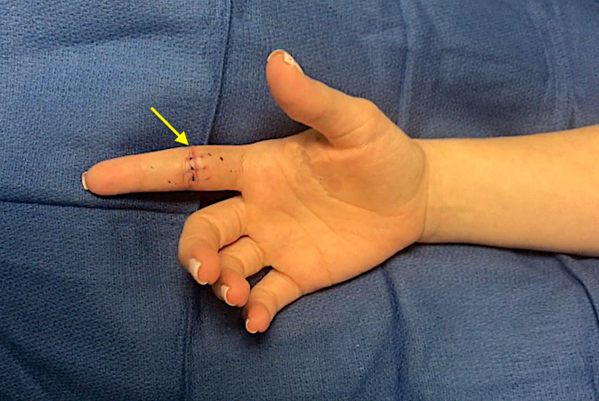 Right index finger laceration of the FDP and partial FDS laceration