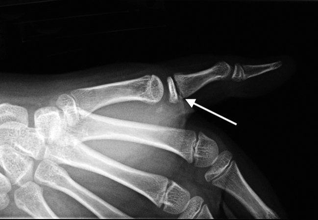 Thumb Proximal Phalanx Fracture Salter I 1/2 (arrow) with widening of epiphysis
