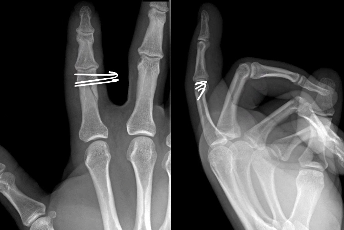 Index proximal phalanx radial condylar fracture after closed reduction and pinning