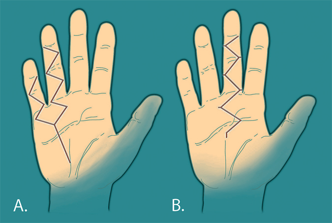 Dupuytren's Incisions - First two common patterns out of many choices