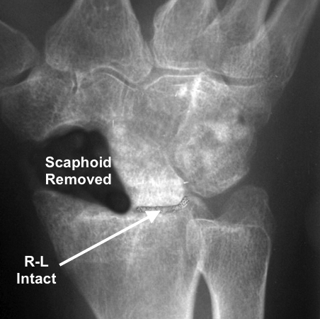 SNAC Wrist with scaphoid excised and intact L-C joint