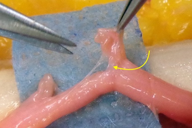 Partial median nerve laceration.  The cut fascicular groups are dissected in the internal epineural plane (arrow) from the intact fascicular groups.