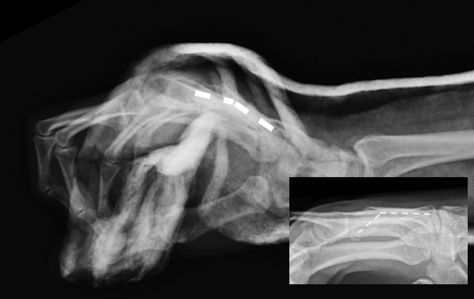 Boxer's Fracture treated with closed reduction and ulnar gutter splint.