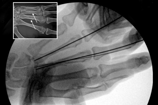  Long and ring spiral oblique metacarpal fractures (AP view) undergoing closed reduction and percutaneous pinning.