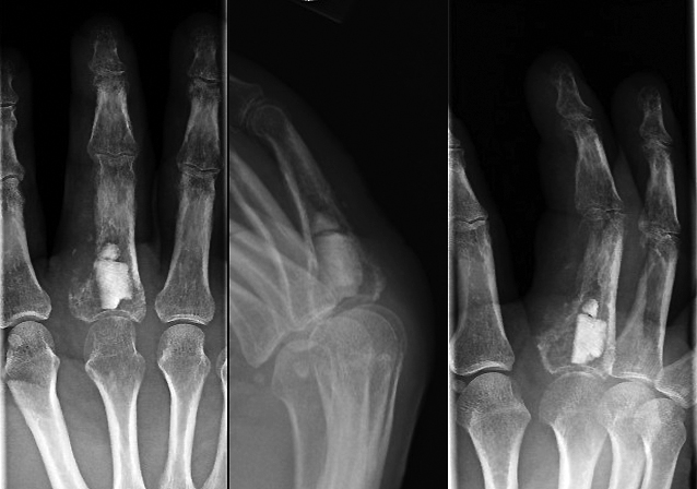 Chondrosarcoma after open biopsy with bone cement to temporarily stabilize phalanx.