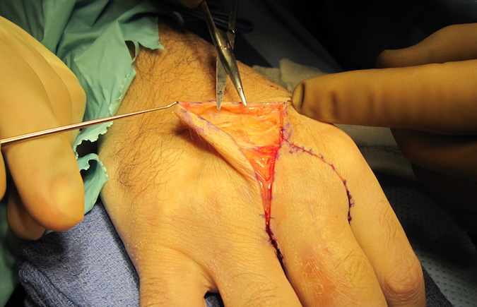 Dissection of dorsum for ray resection