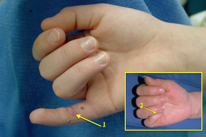 Three week old right fifth flexor tendon laceration.  Note patient has already learned to use finger trapping (insert) to flexion the fifth finger