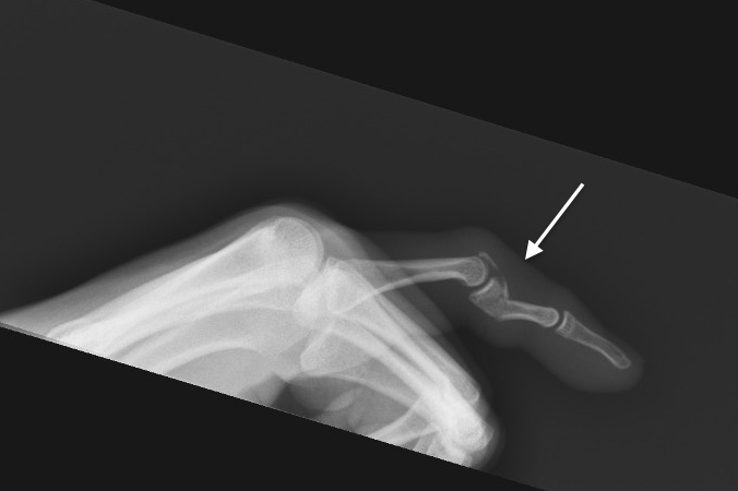 Central slip avulsion fracture with simultaneous volarly angulated base fracture