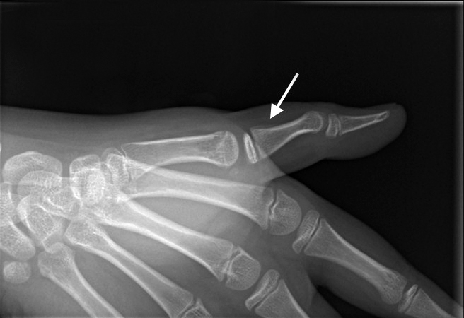 Thumb Proximal Phalanx Fracture Salter II with healing callus (arrow)