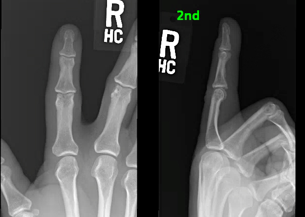 Index proximal phalanx radial condylar fracture after pin removal and fracture healing