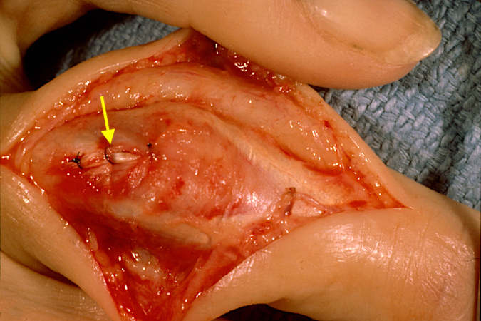 Complex PIP dislocation with repaired lateral band and central slip.