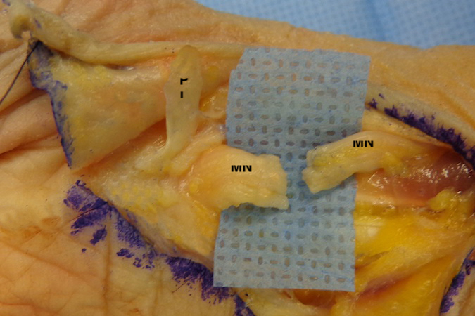 Median Nerve (MN) Laceration with cut palmaris longs (PL). Exposure extended.  Note the elastic gap between the nerve endings.