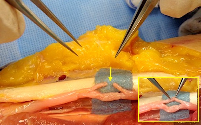 The cut fascicular groups have been separated from the intact groups. Note the minimal force needed to approximate the cut ends (insert).