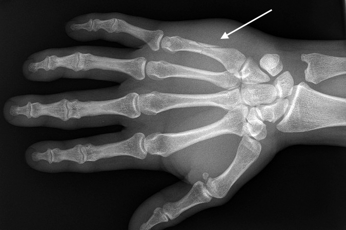Fifth metacarpal spiral shaft fracture with non displaced butterfly fragment AP (arrow).