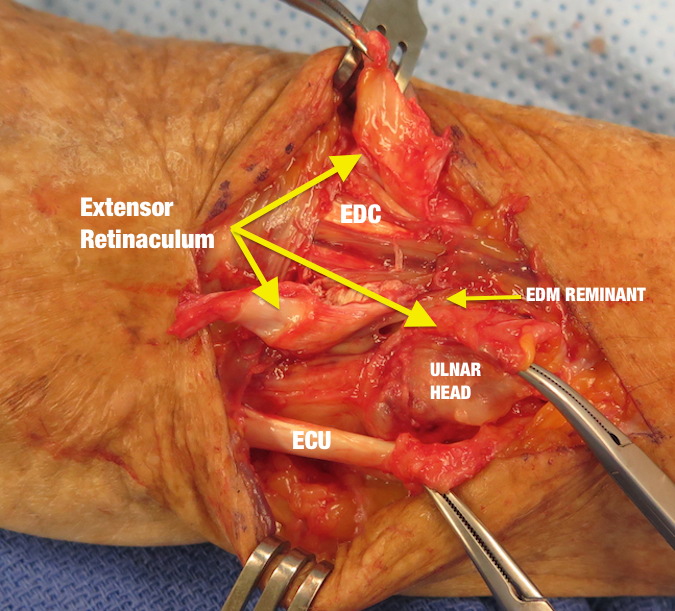 Retinacular Flaps Made & Intact Extensors Exposed