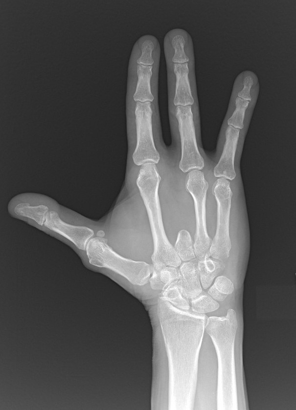 Chondrosarcoma after ray resection for en bloc excision