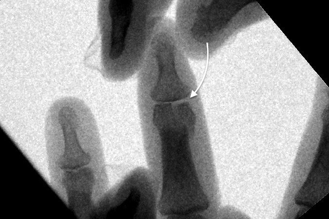 Middle phalanx displaced intra-articular radial condyle fracture