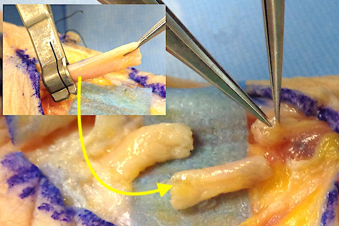 Median Nerve (MN) Laceration - note the true defect when a segment of nerve is removed in this anatomic specimen.