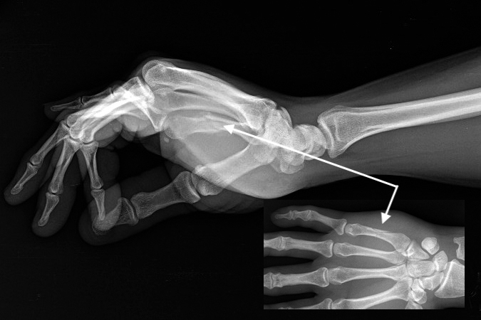 Fifth metacarpal spiral shaft fracture with non displaced butterfly fragment treated with a cast.  Note callus.