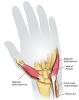 Huber opponensplasty - often used with children with congenital thenar hypoplasia that frequently accompanies radial agenesis. In step 1 the abductor digits minimi is detached distally, free from surrounding structure and left attached to the neurovascular bundle and pisiform area.