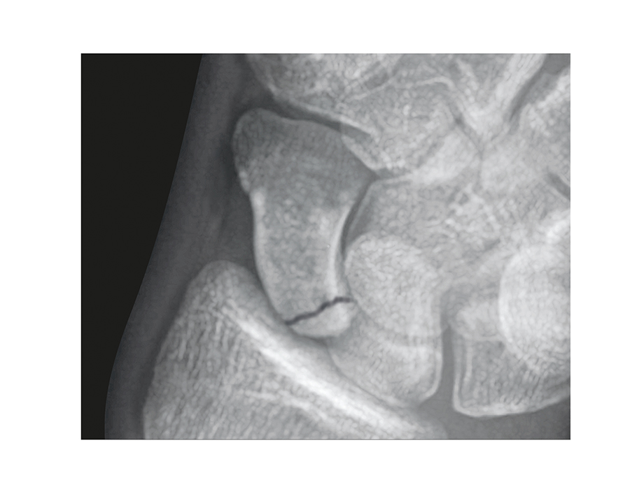 Scaphoid (Navicular) Fracture Middle 1/3 Proximal 1/3 Non- Displaced.  This fracture will be at very high risk for AVN and ORIF should be considered.