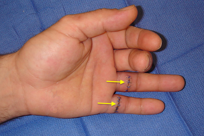 Left ring and little finger FDP and FDS tendon lacerations in "No-Man's land".  Note the loss of the normal resting finger posture