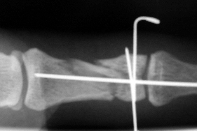 Comminuted intra-articular middle phalanx fracture after ORIF