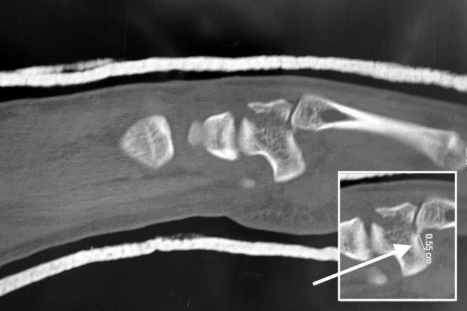 Fifth CMC joint fracture dislocation with displaced dorsal fragment and CMC joint (arrow).