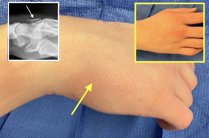 Fifth CMC joint fracture dislocation with minimal clinical deformity (arrow & insert) but obvious on X-ray insert.
