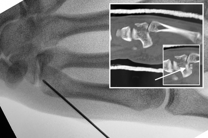 Fifth CMC joint fracture dislocation ORIF step 1 - pin in the base of the fifth metacarpal.