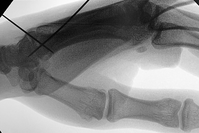 Fifth CMC joint fracture dislocation lateral X-ray after ORIF step 2.