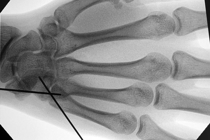 Fifth CMC joint fracture dislocation ORIF step 2 - Dislocation reduced and the pin in the comminuted dorsal hamate fragment is advanced into the metacarpal base.  Next, the pin in the base of the fifth metacarpal is advanced across the joint and into the hamate body.  The metacarpal base pin is advanced last so it will not block the reduction of the dorsal hamate  fragment.