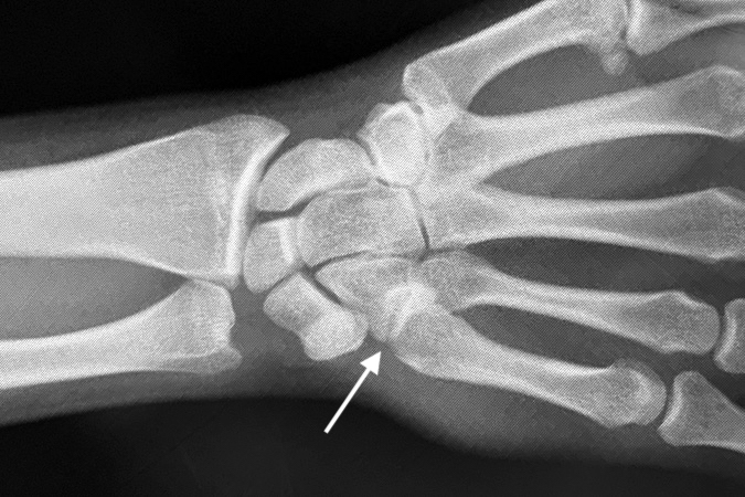 Fifth CMC joint fracture dislocation with minimal bony overlap (arrow).