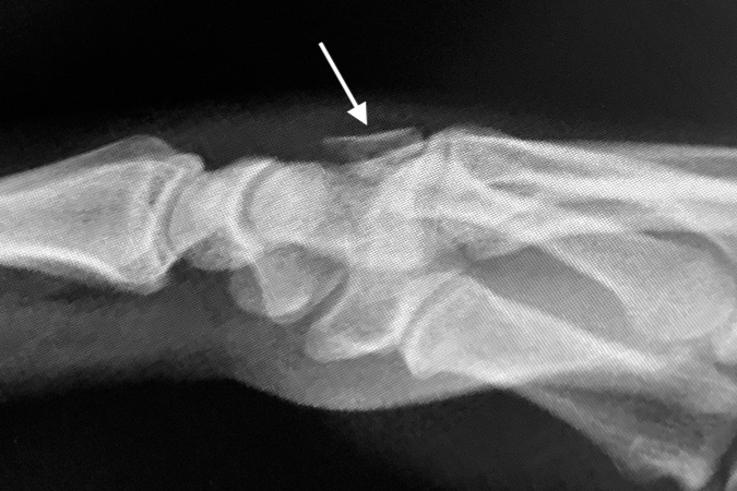 Fifth CMC joint fracture dislocation with displaced dorsal fragment (arrow).