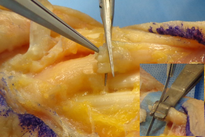 Median Nerve (MN) Laceration - with ragged edges of nerve endings removed with serrated micro-scissors or nerve cutting tool (insert).