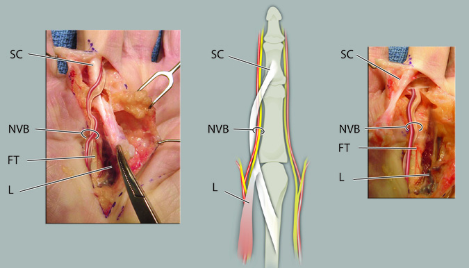 Spiral cord moving the neuromuscular bundle proximally, superficially, and centrally.