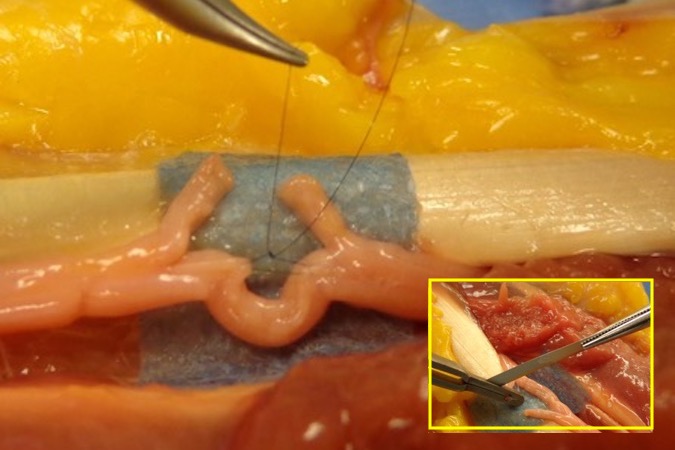 Tension temporarily controlled with a single 8-0 suture.  Cut ends trimmed with nerve cutting tool (insert).