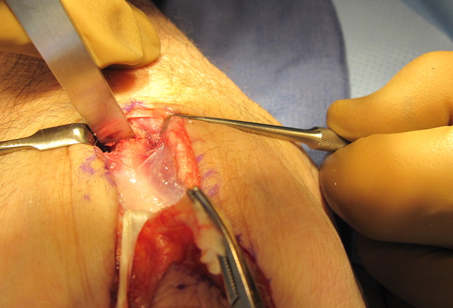 Osteotomy of metacarpal shaft proximally