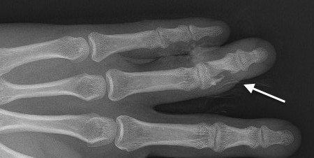 Open right ring middle phalanx shaft fracture